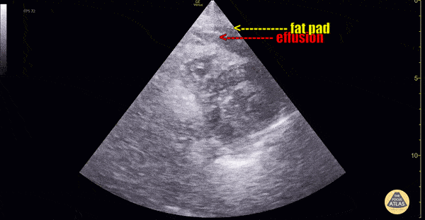 Pericardial Effusion Vs Fat Pad [2/2]