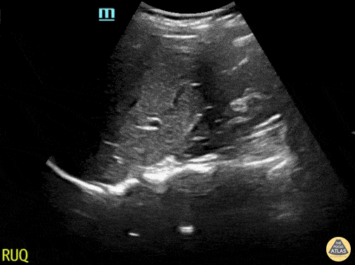 Normal RUQ Evaluation