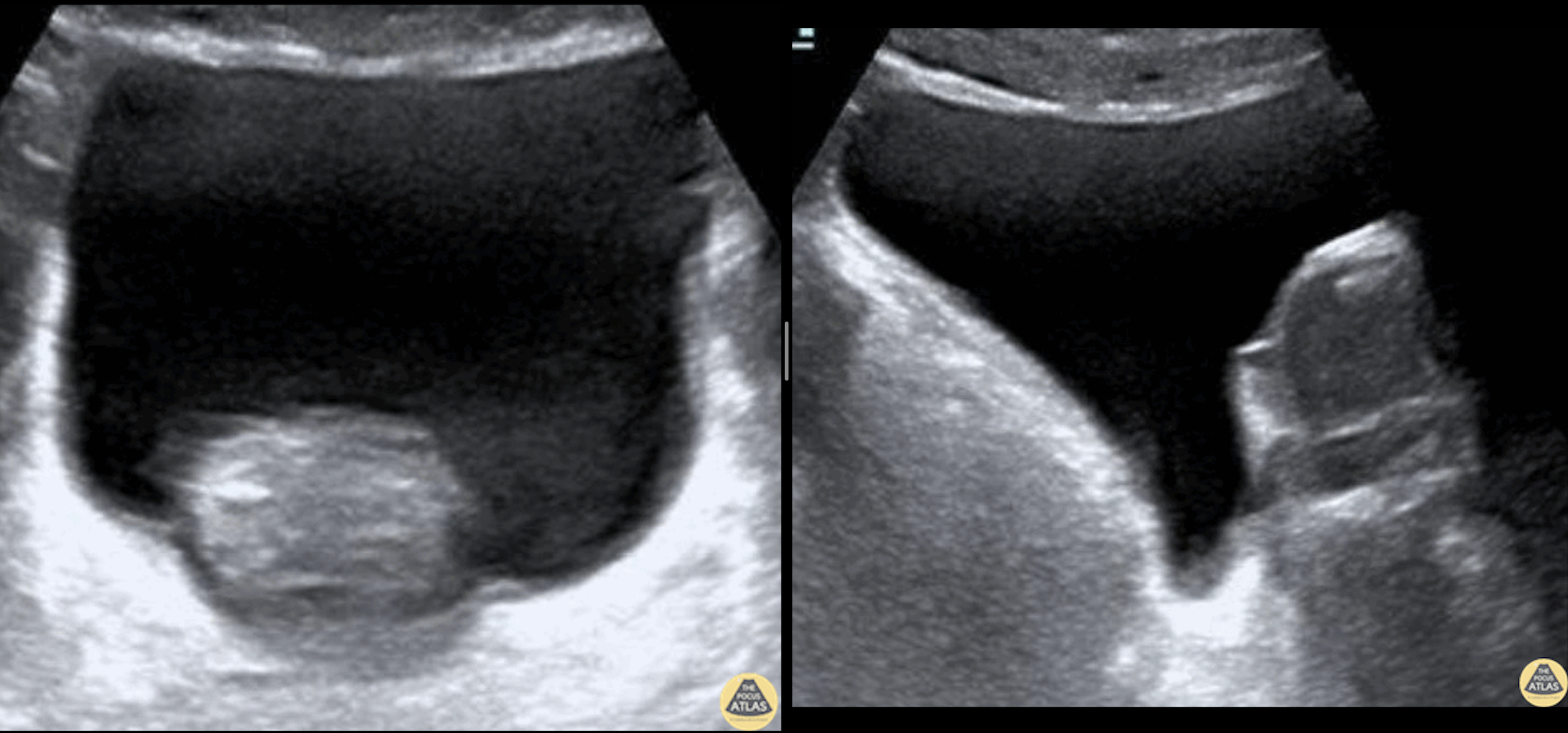 Renal/GU — TPA
