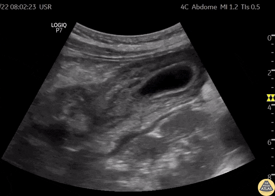 Thick Walled Gallbladder in Dengue Fever (Long Axis) [1/2]