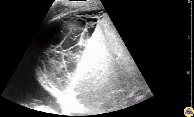 Loculated Collection Within Liver
