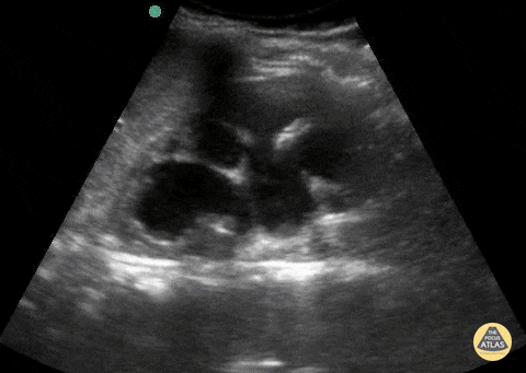Hydronephrosis