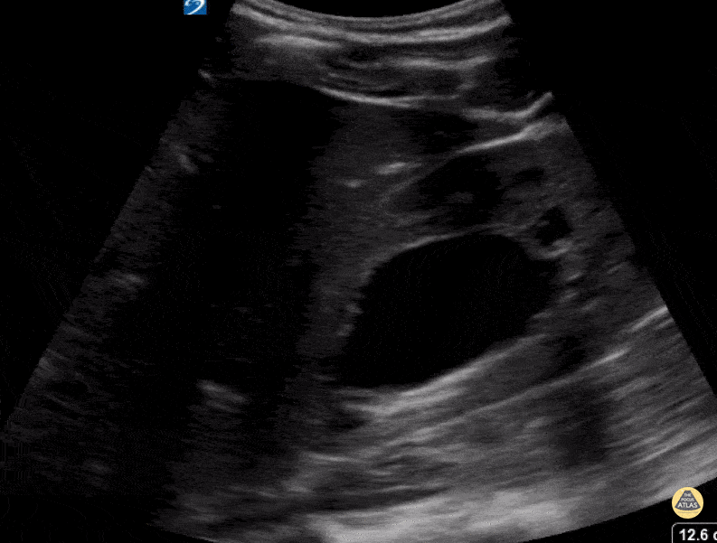 Severe Hydronephrosis
