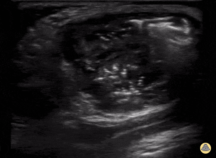 Inguinal Hernia into Scrotum