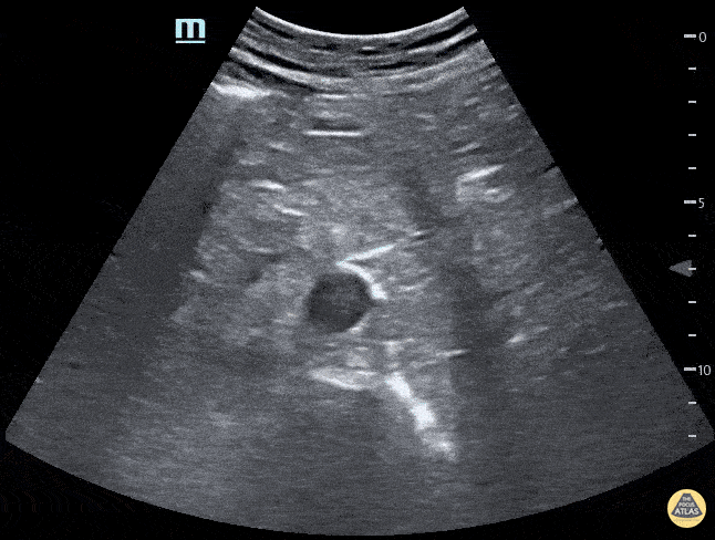 Renal/GU — TPA