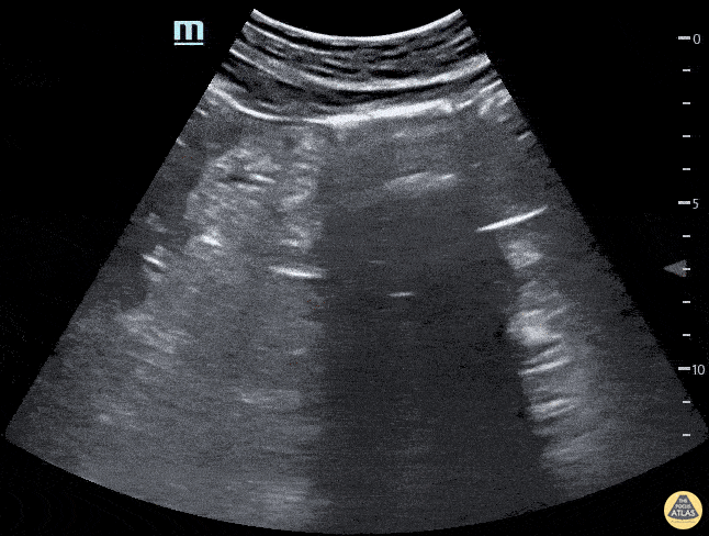 Renal/GU — TPA