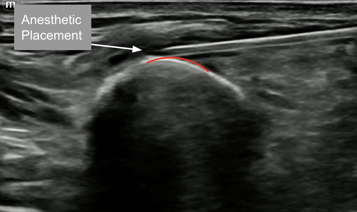 Clavipectoral-US-2.png