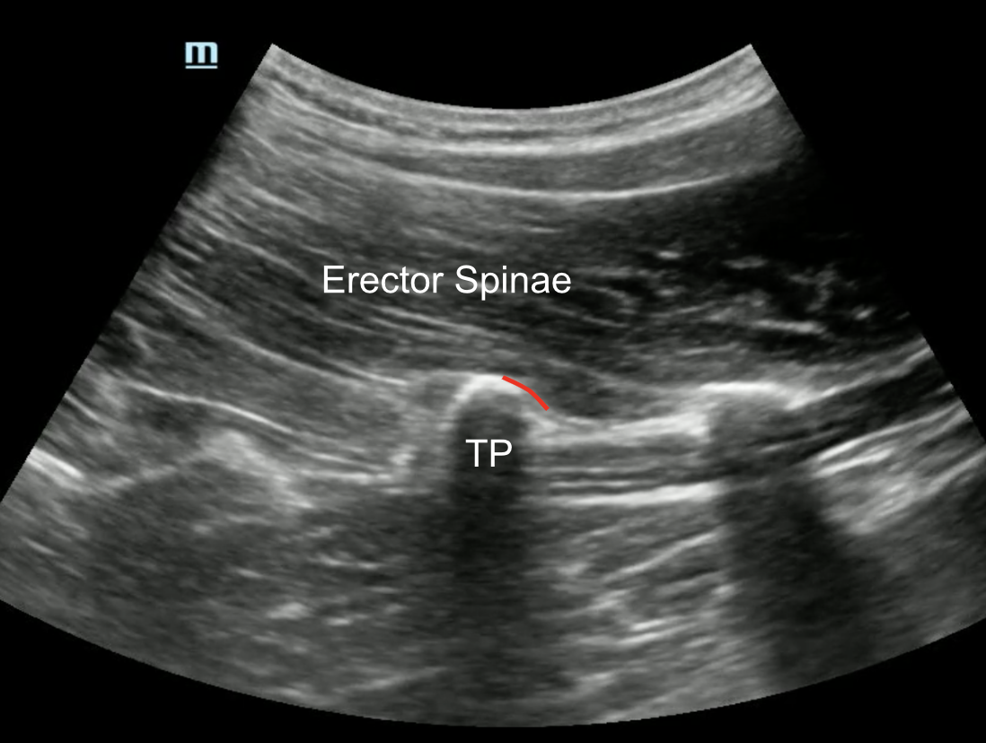 Lumbar-ESP-US-2.png