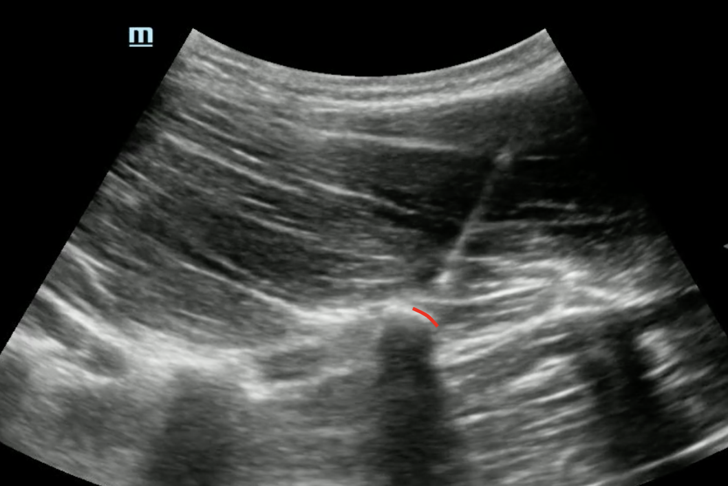 Lumbar-ESP-US-1.png