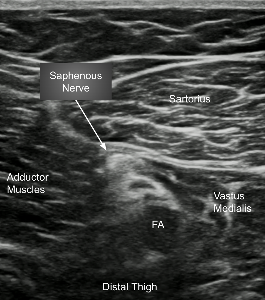 Saphenous-US-2.png