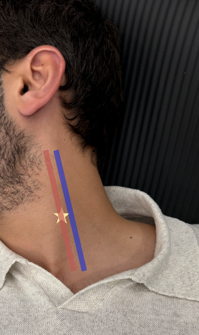 Stellate-Ganglion-area-of-anesthesia.png