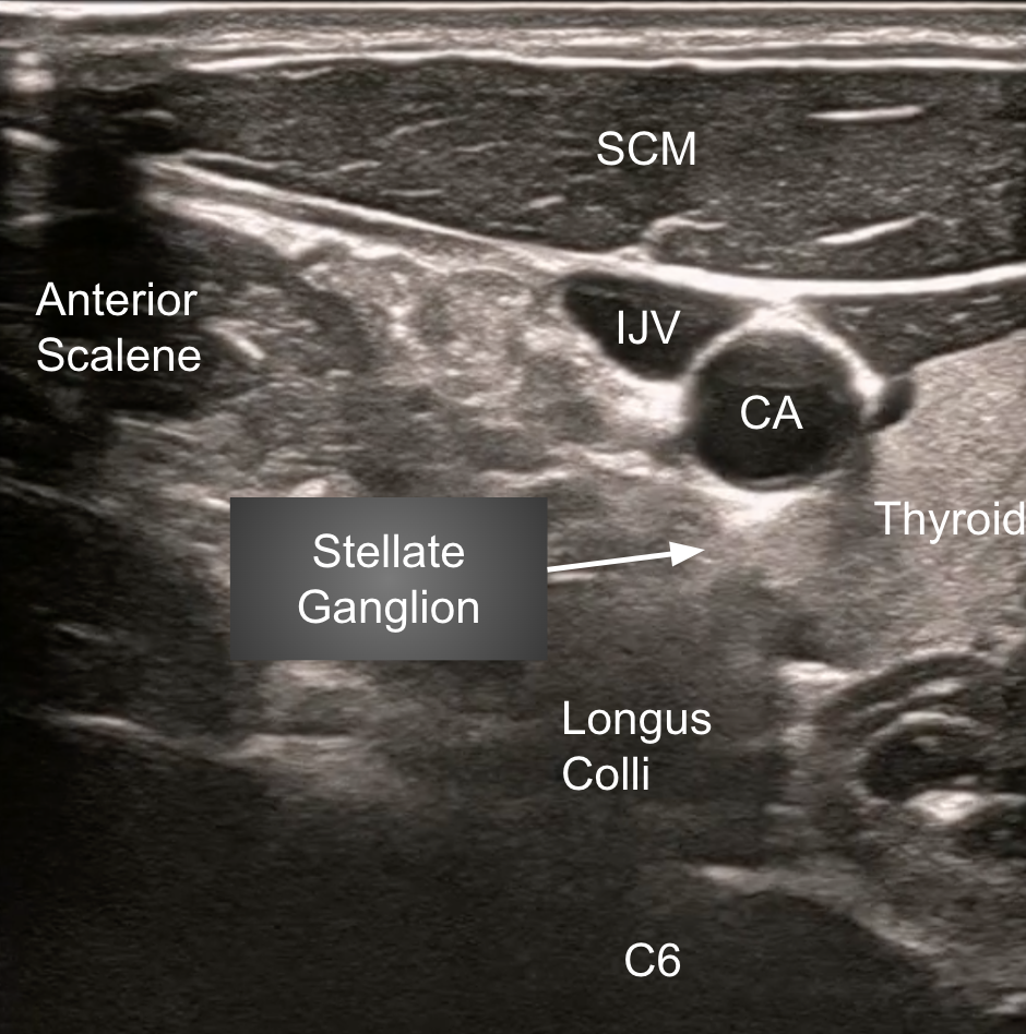 Stellate-Ganglion-US-1.png