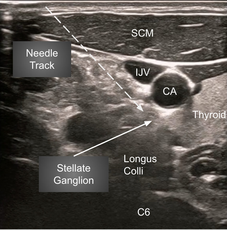 Stellate-Ganglion-US-labeled.png