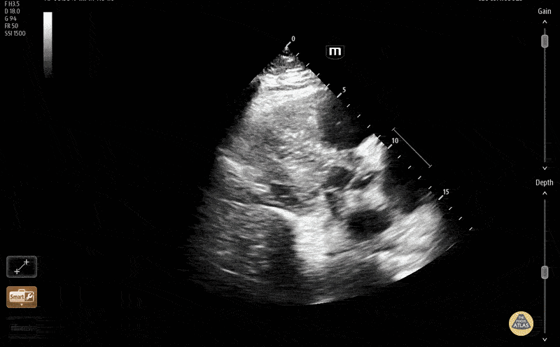 Large RV Mobile Thrombus [1/2-Long Axis]