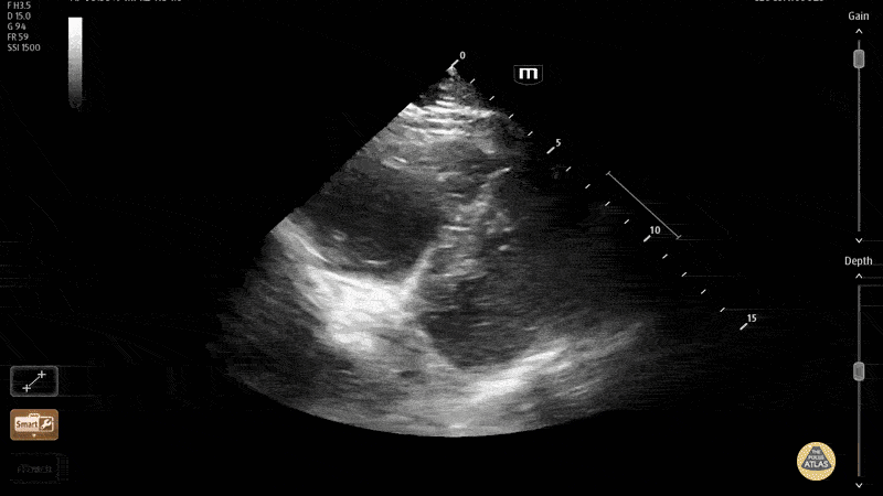 Large RV Mobile Thrombus [2/2-Short Axis]
