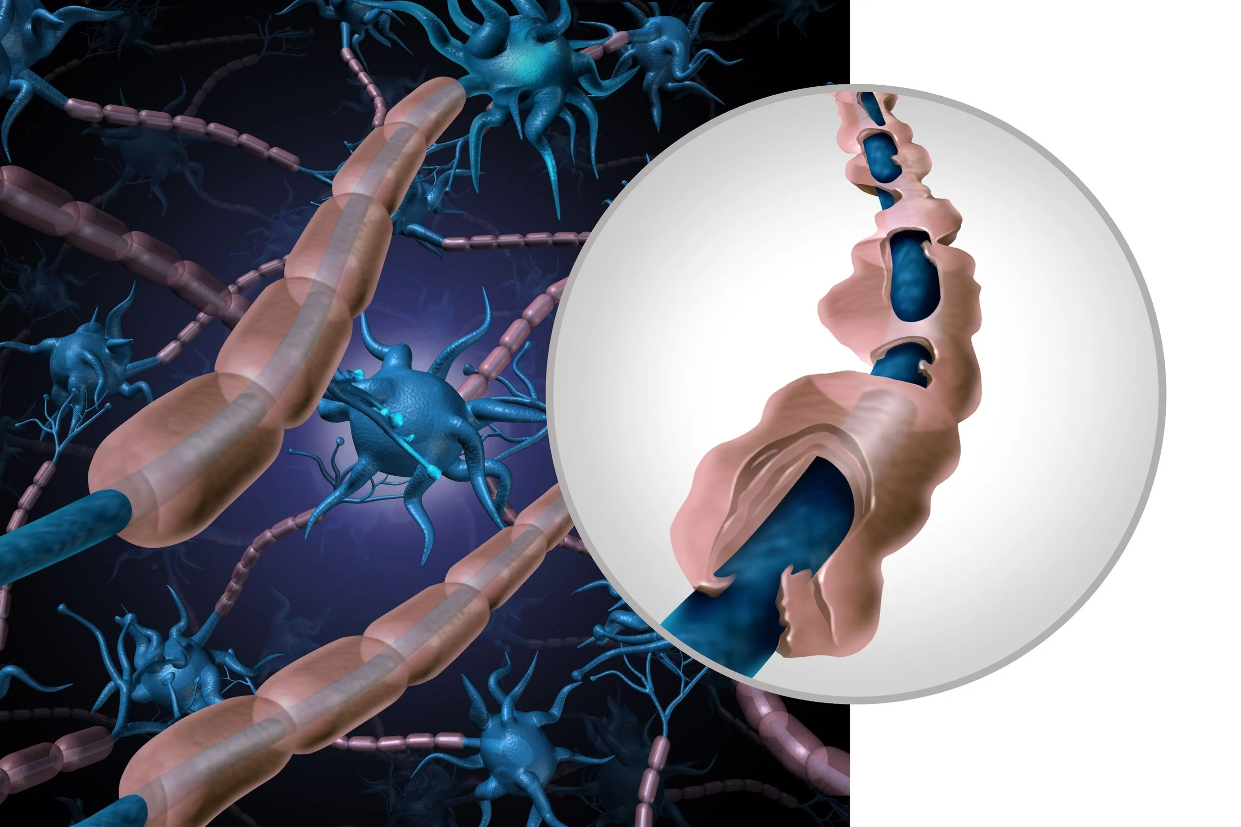 Occupational Therapy and Multiple Sclerosis Rebound Health