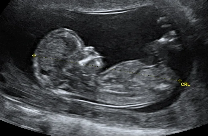 Resuscitative Hysterotomy - Peri-Mortem C-Section