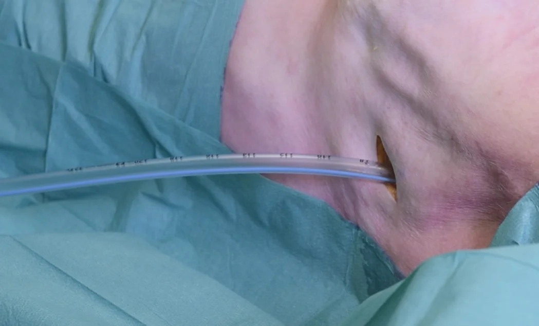 Pleural Decompression & Drainage