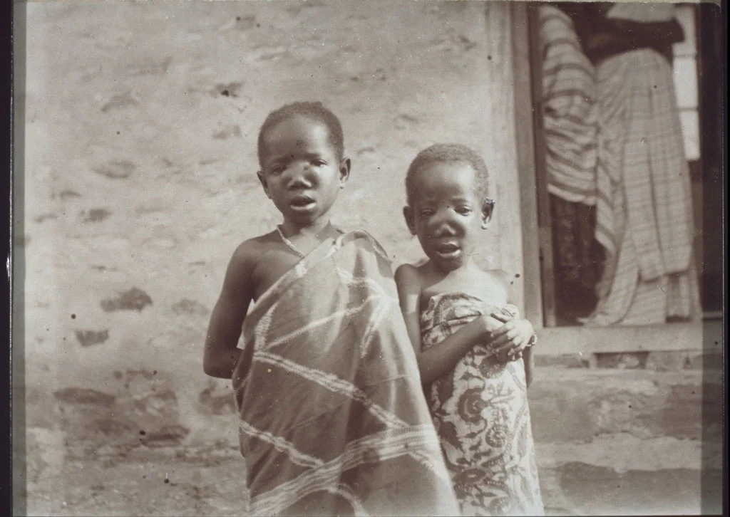 Children with inherited syphilis scars.