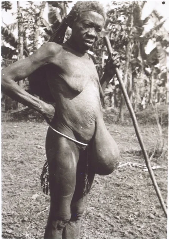 Woman with hernia.