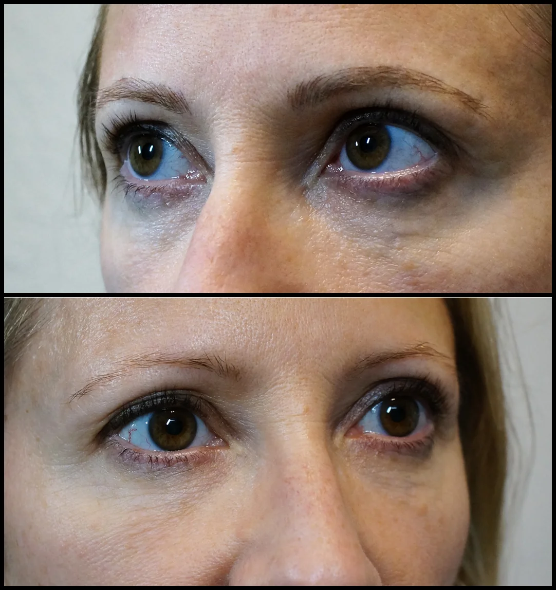 Before is on the bottom, After on the top.