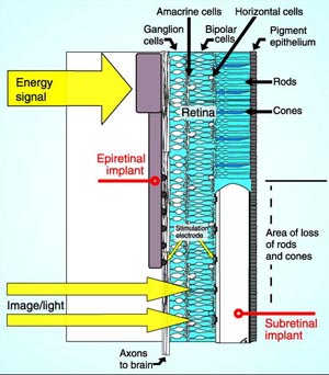 The Argus II is an epiretinal implant. The Implant AG is a subretinal implant. 