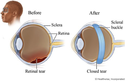 Image Credit: https://www.texomaretina.com/services-2/common-treatments/scleral-buckle/