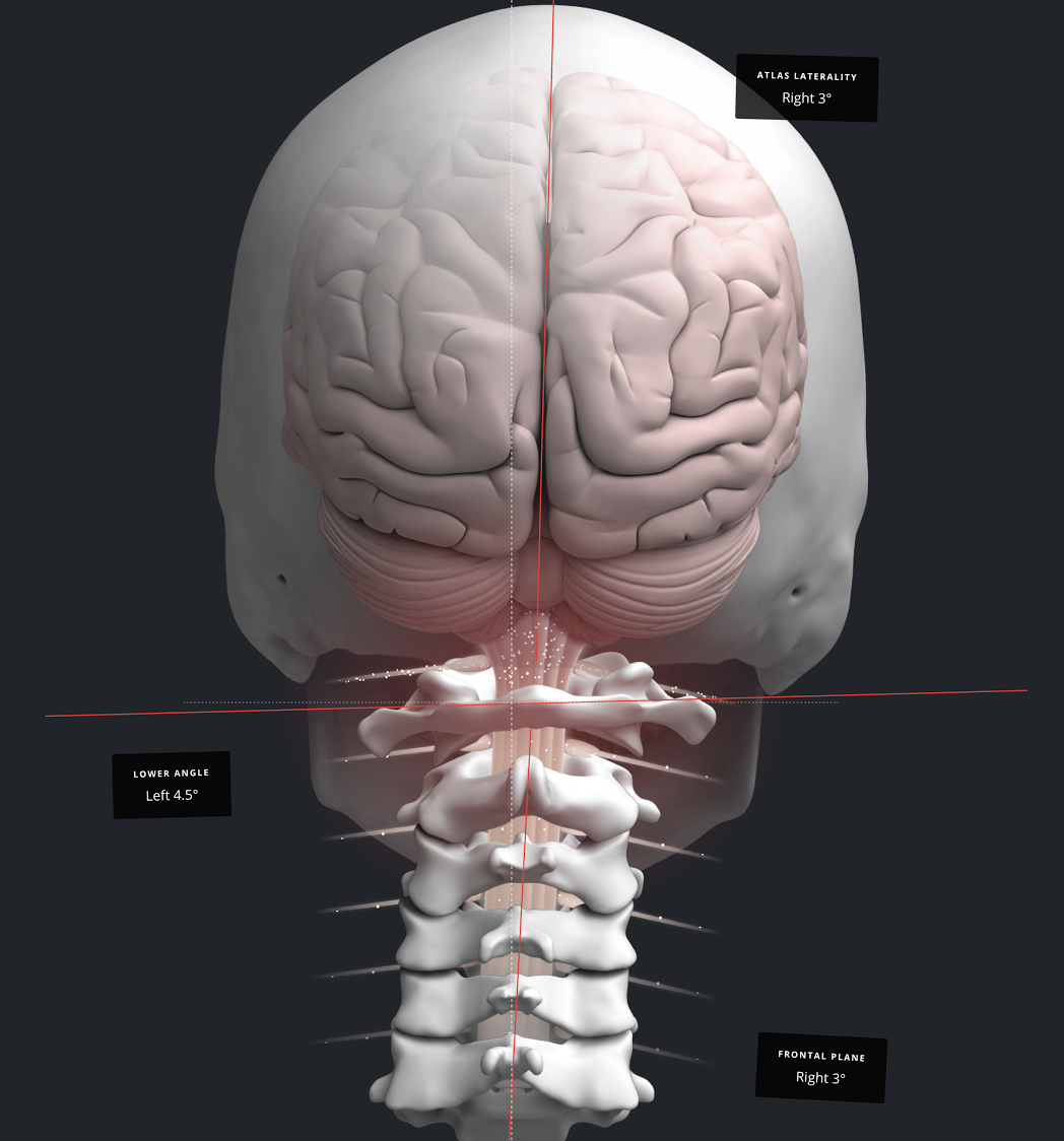 Treatment For Vertigo Dizziness Los Angeles Vital Head Spinal Care Treatment For Vertigo Dizziness Los Angeles Vital Head Spinal Care
