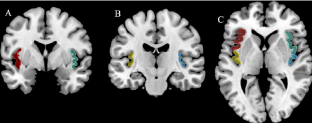 [Image is taken from  Systematic Meta-Analysis of Insula Volume in Schizophrenia  (2012) by Alana M. Shepherd, Sandra L. Matheson, Kristin R. Laurens, Vaughan J. Carr &amp; Melissa J. Green]