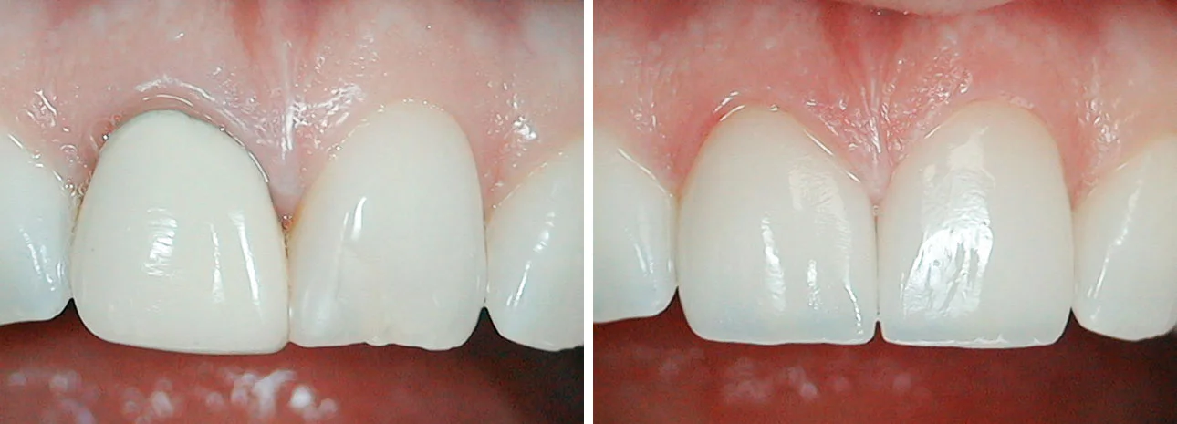 Crown Makeover Patient treated with 6 ceramic (eMax) crowns to restore her worn and eroded front teeth. This type of damage is seen in patients with a history high acid exposure, either due to diet, like lemon sucking, or to an eating disorder, such as Bulimia.