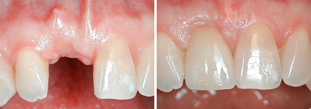 Missing Front Tooth Patient had her front tooth knocked out in an accident. It took about 10 months to complete her replacement, but it is currently the best way to ultimately replace a tooth and put a patient back to their original smile.