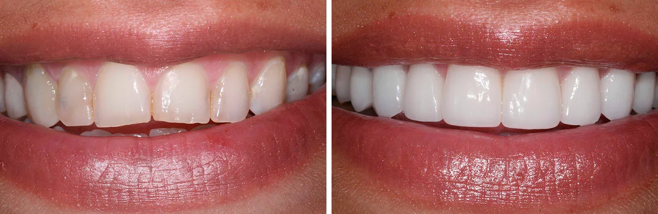 Confident New Smile This patient had multiple stained and chipped teeth and felt unhappy with her smile. She was treated with 10 veneers to create a more esthetic and confident smile.