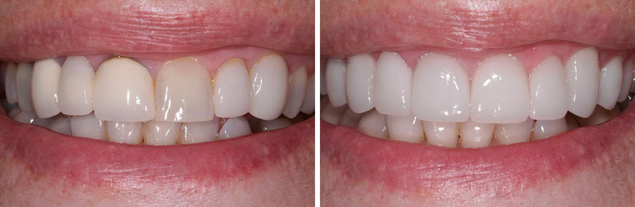 Full Mouth Makeover We take detailed records, photos, xrays and diagnostic study models of each patient in order to create the ideal treatment plan. We usually have a mock up final design of how we expect treatment to go and how your smile will appear, so that you can get a better idea of the final outcome before treatment even begins.