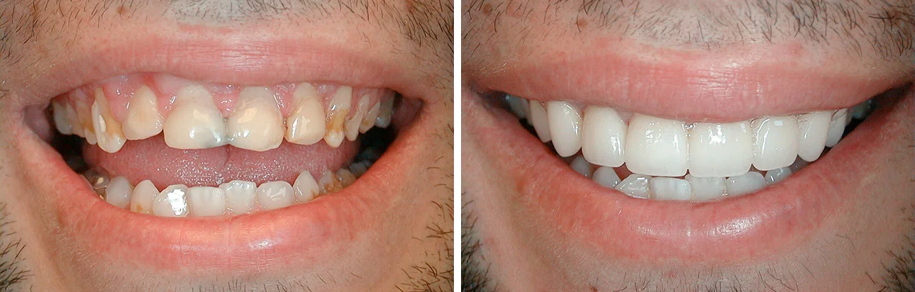 veneers8.jpg
