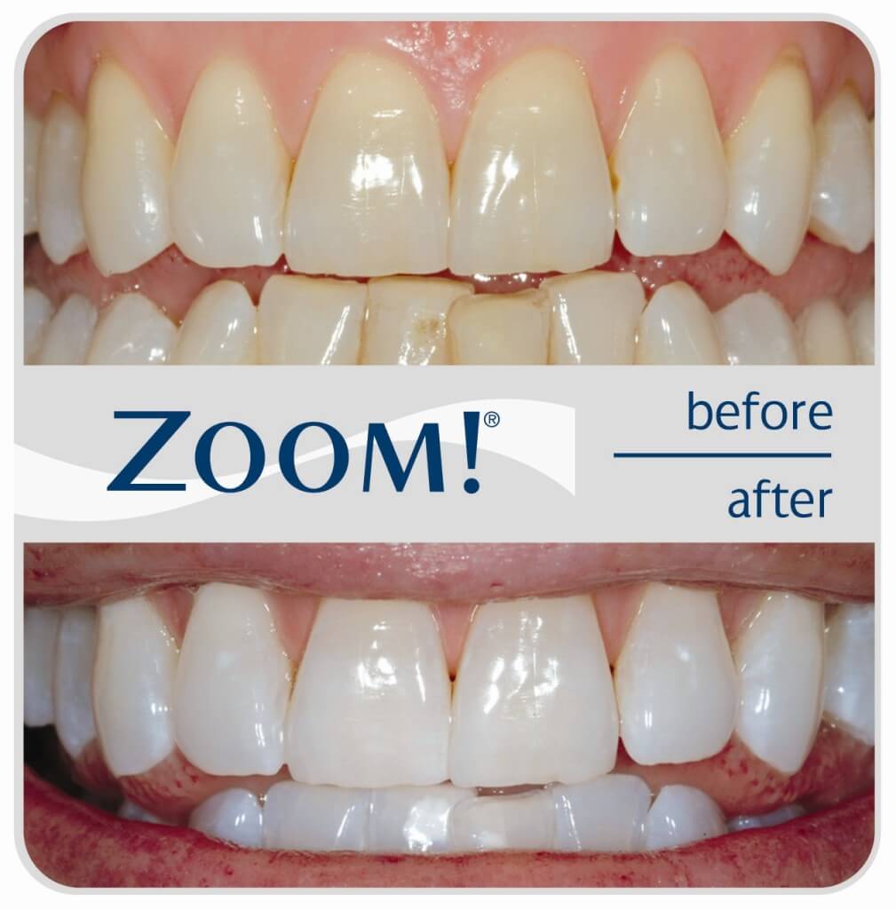 ZOOM-Before-After-1009x1024.jpg