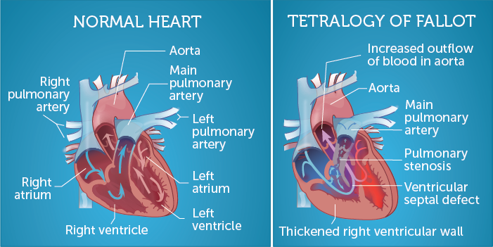 The difference between a normal heart and a heart with ToF. Image from an overview of ToF by Boston Children's Hospital.
