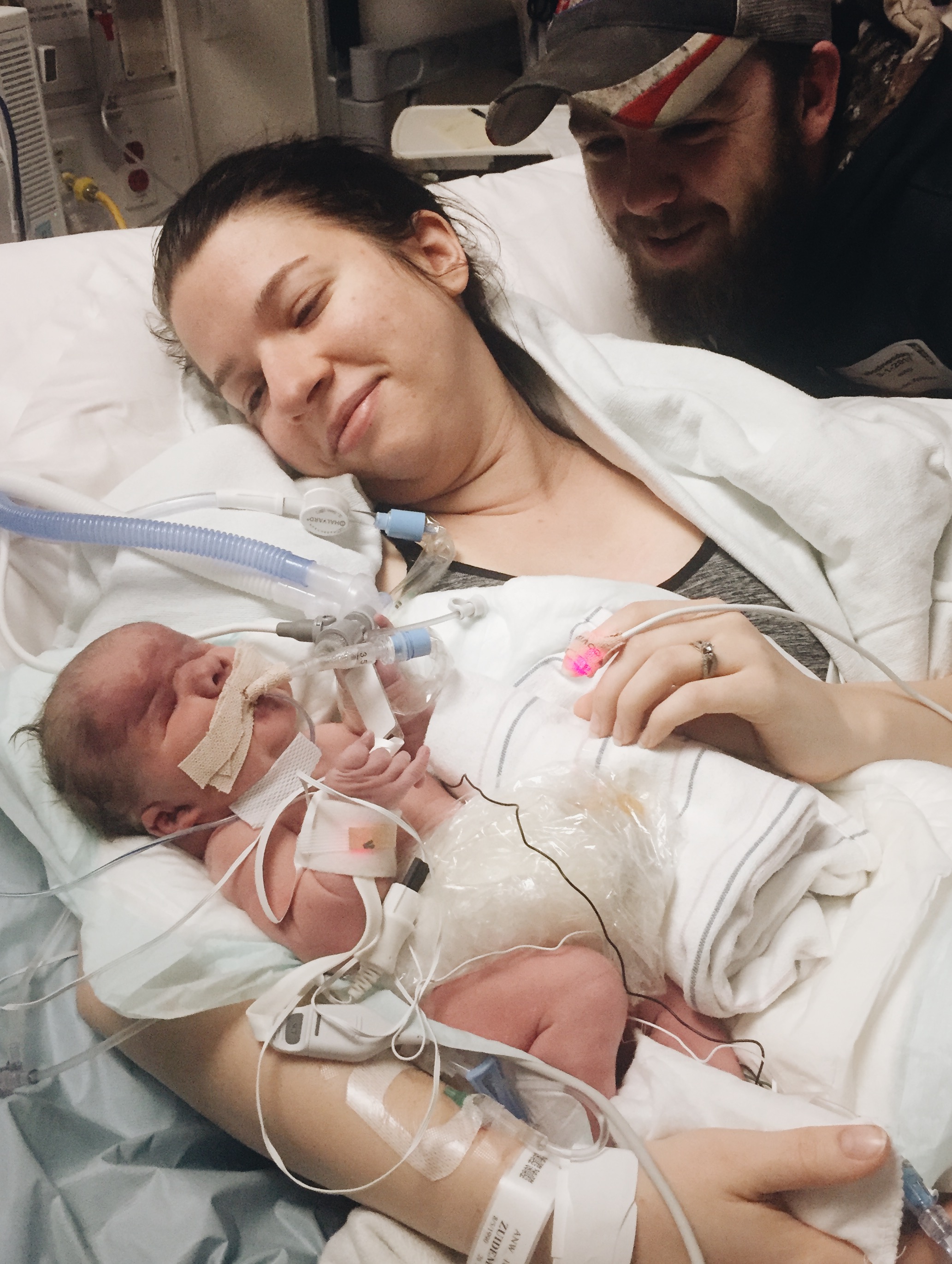 The first time I held Norah, legs still numb and body still swollen from surgery.