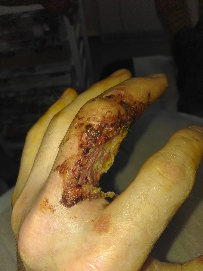 Jack's injury developed and he needed a skin graft