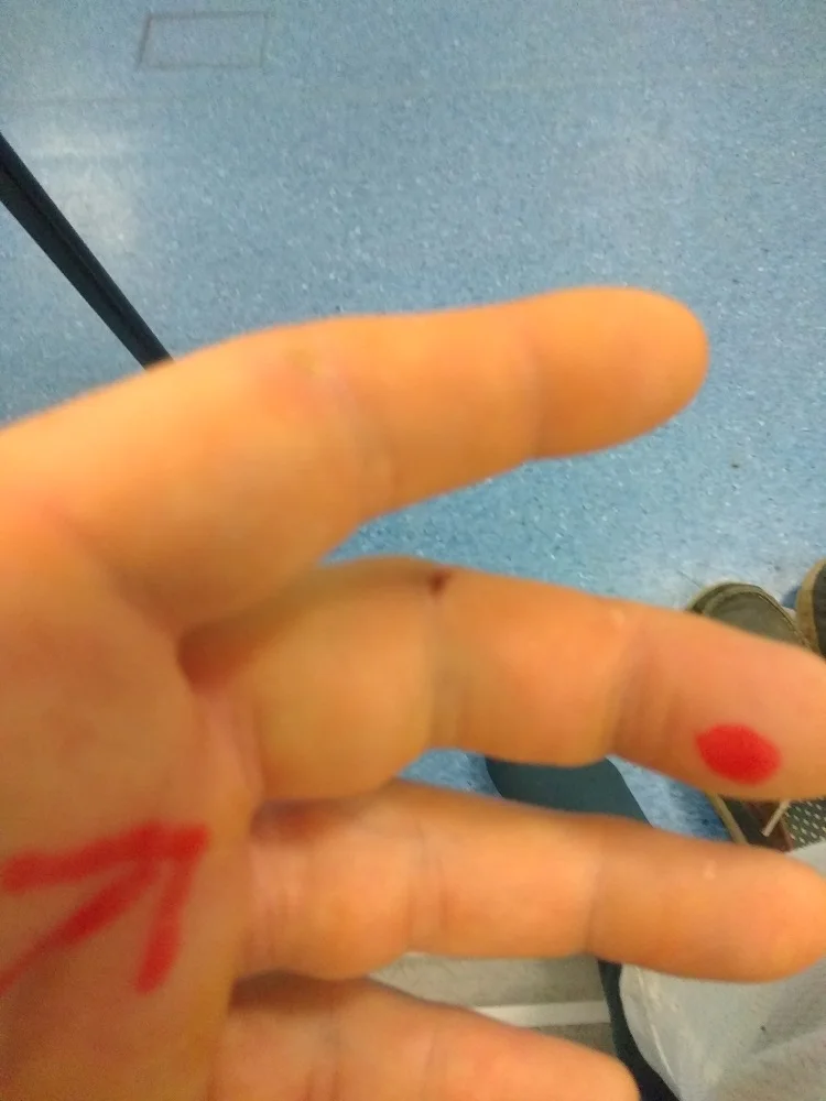 The tiny cut that turned into a horror story for Jack