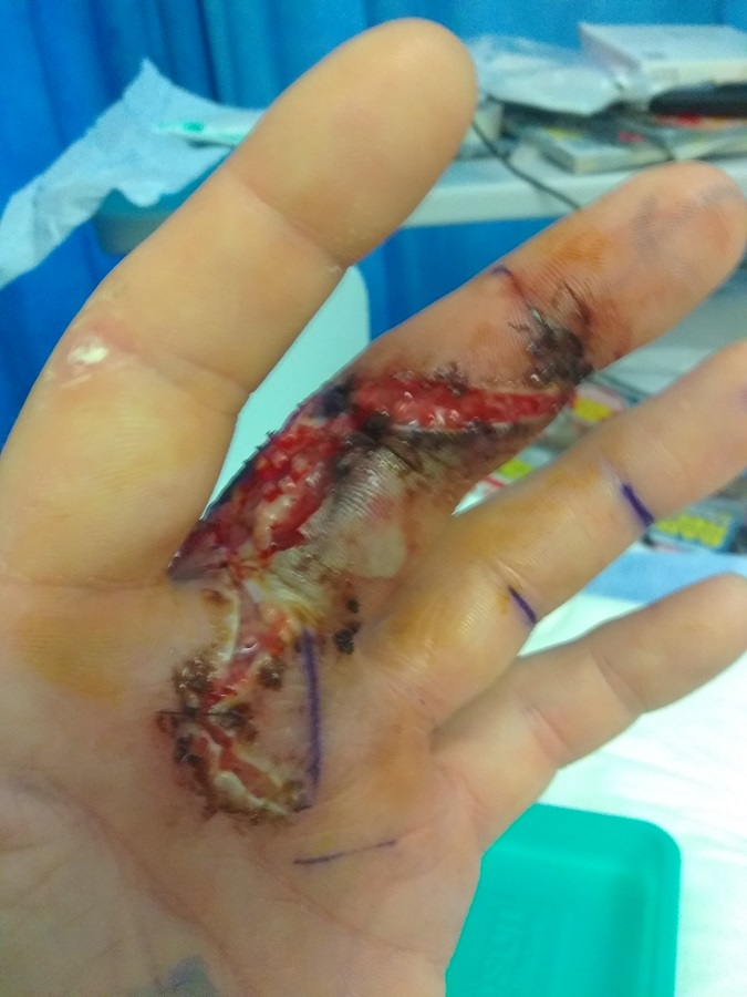 The flesh on Jack's finger rotted away