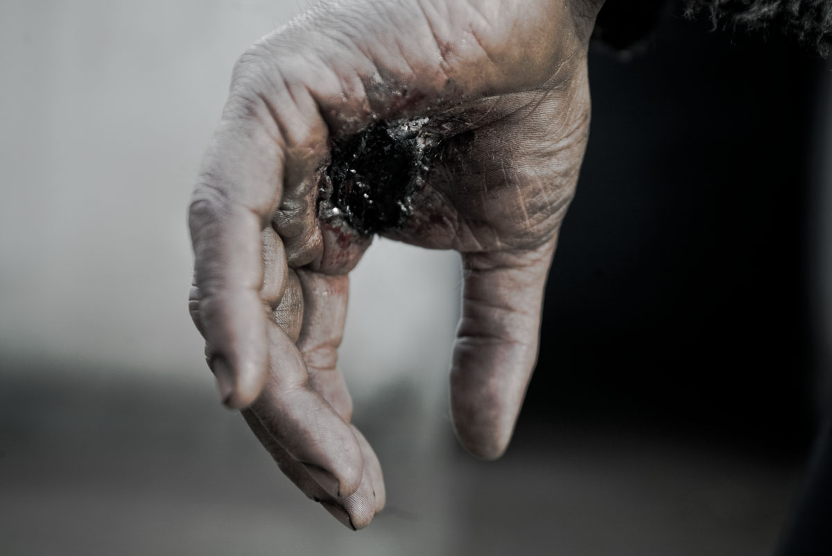  The wound on hand which got worse as the film went on.
