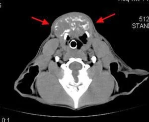 Computed tomography (CT) image of patient with a large, firm mass on the ventral neck overlying the trachea. The mass was too invasive to remove surgically, therefore radiation therapy was used to slow the progression of the cancer. Red arrows point to the thyroid mass.