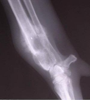 Radiograph of a patient with osteosarcoma. The lesion is seen in the distal radius and ulna of the forelimb and is characterized by lysis and production of bone .