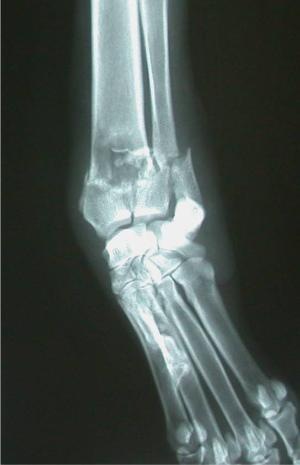 A "pathologic” fracture (a fracture that occurs because there is underlying pathology in the bone) in the radius and ulna of a seemingly normal dog that jumped out of a truck and yelped in pain. This radiograph also shows a classic bone tumor lesion. Pathologic fractures are difficult to repair and therefore amputation is usually necessary on an emergency basis.