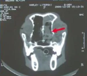 Pre-radiation therapy CT scan. Red arrow points to tumor.