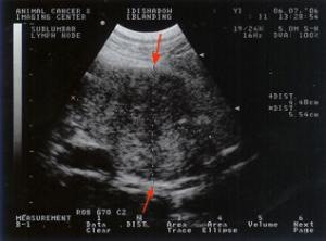 Picture of an abdominal ultrasound on a patient with AGA. The red arrows point to an enlarged sublumbar lymph node, a common finding in patients with this disease.CT scan may be recommended in some cases, especially where surgery or radiation therapy are being considered.