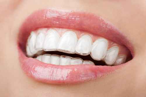 invisalign-brace.jpeg