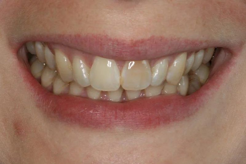 Fixing discoloured teeth - Before