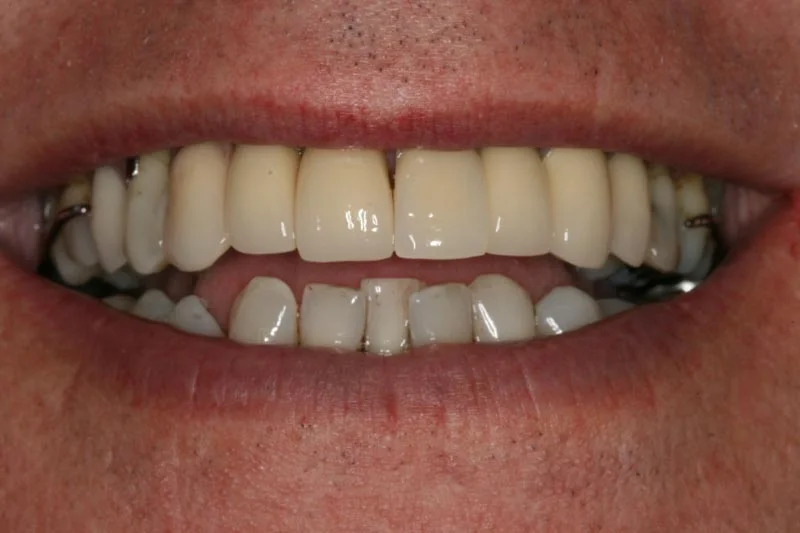 Avoiding the dentist for years - After