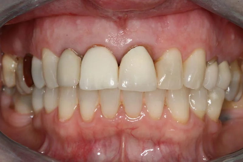 Fixing failing dental crowns - Before